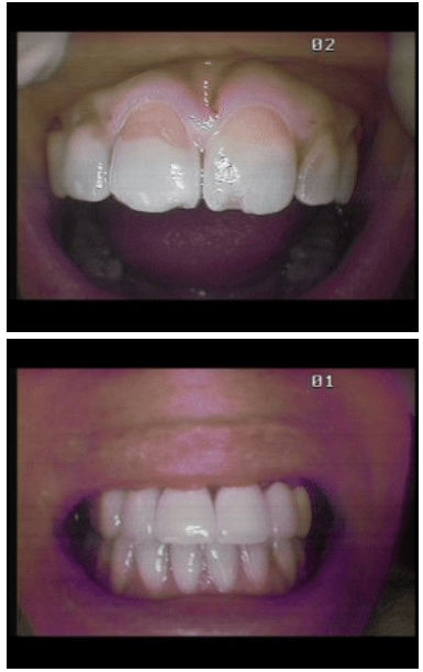 Zirconia Marina Del Rey