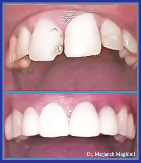 Porcelain Zirconia crowns marina del rey