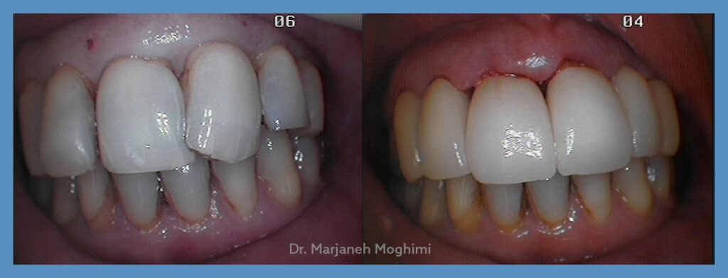 Dentist Marina del Rey - patient smile results at Elegant Dentistry